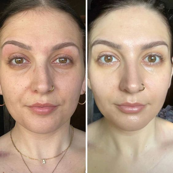 Before and After